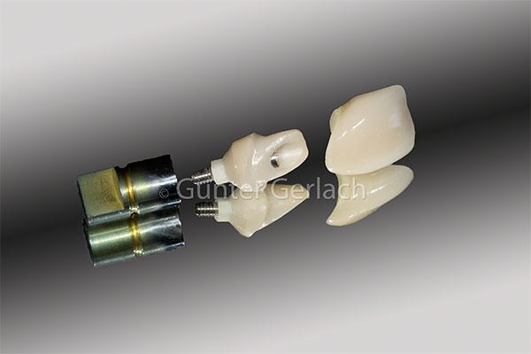 Implantatprothetik: Keramikimpl._m._11_Vk_MG_6679.jpg